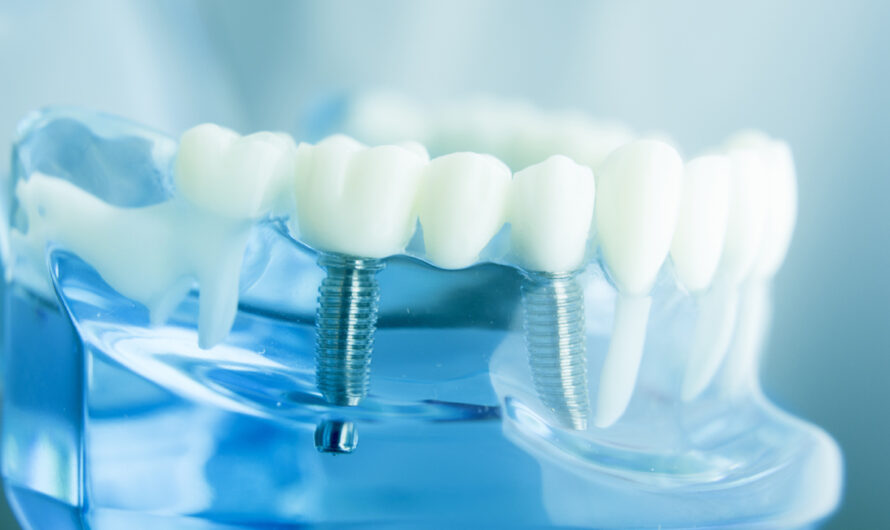 Dental Implant Market contributing large share In Global Market