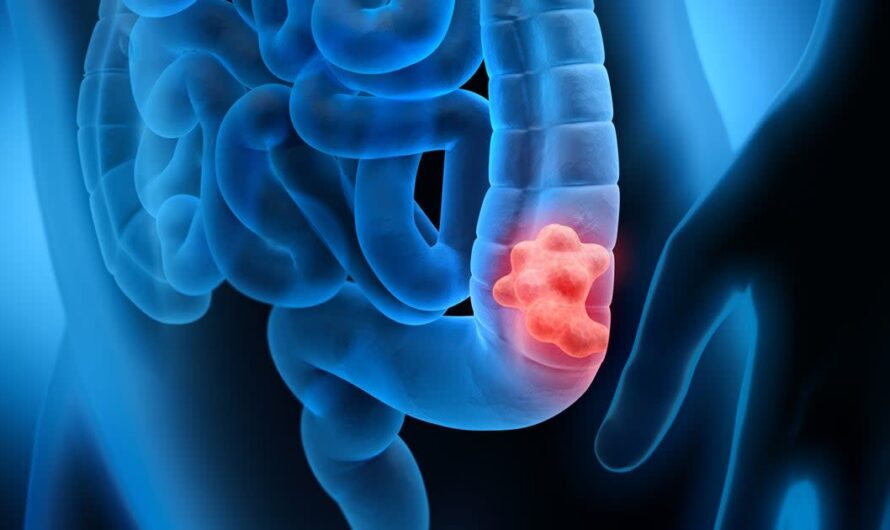 Colorectal Cancer Screening Market Is Expected To Be Flourished By Growing Screening Program Initiatives By Governments And Public Organizations