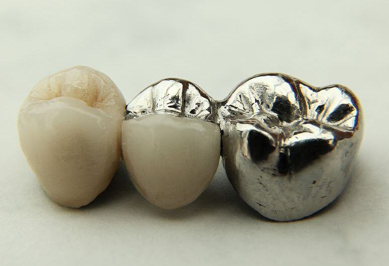 Stainless Steel Crowns Propelled By Rising Demand For Aesthetic And Long-Lasting Dental Treatments