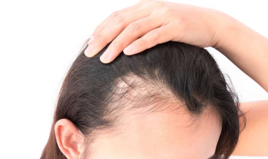 Alopecia Treatment Market Propelled by Increasing Prevalence of Alopecia