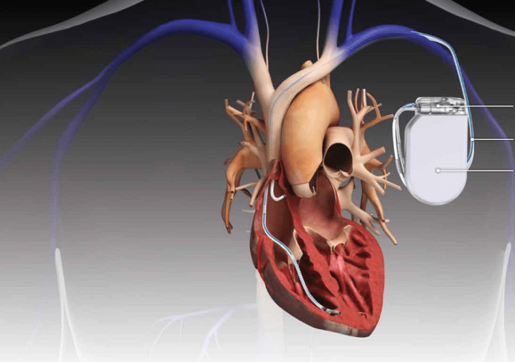 Cardiac Implants Market
