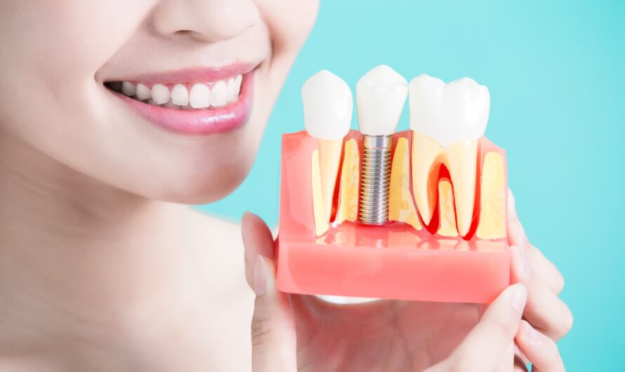 Dental Implants Market Propelled By Increasing Demand For Aesthetic Dentistry