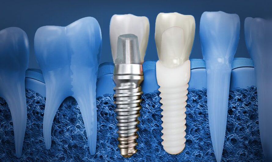 The Global Dental Implants Market is projected to driven by Rising Dental Tourism