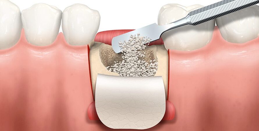 The Latin America Bone Graft And Substitutes Market Is Driven By Growing Geriatric Population