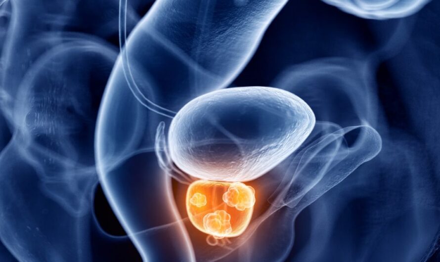 Castrate Resistant Prostate Cancer Market is Estimated to Witness High Growth Owing to Advancements in Immunotherapy