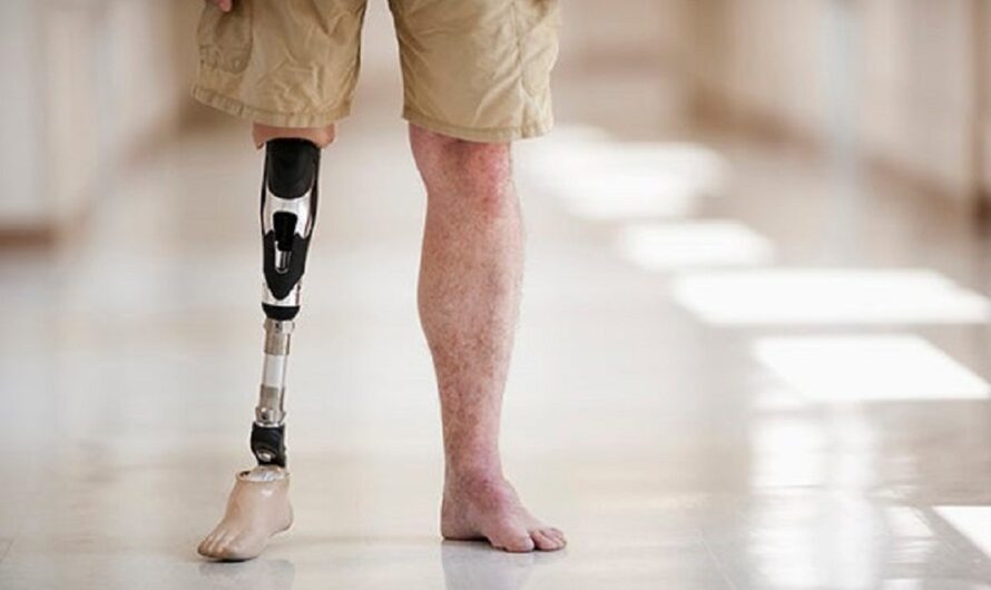 Orthopedic Prosthetics: An Innovation to Restore Lost Mobility